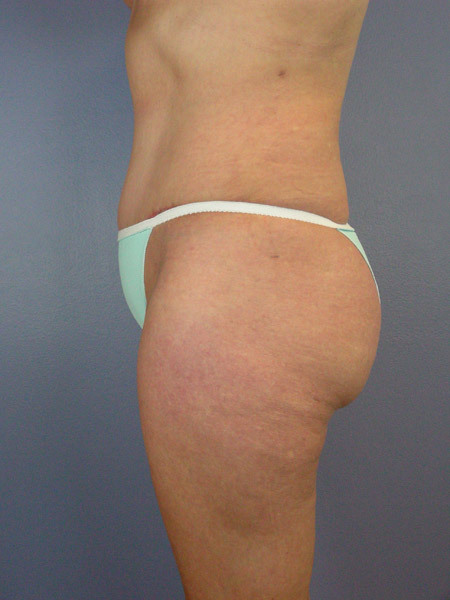 Liposuction before and after photo