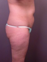 Liposuction Before and after photo