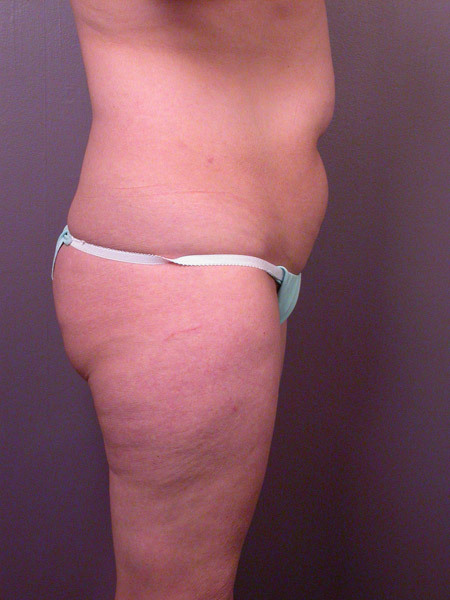 Liposuction before and after photo