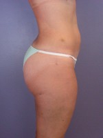 Liposuction Before and after photo