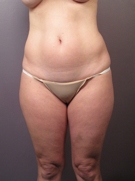 Liposuction before and after photo