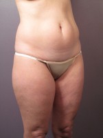 Liposuction Before and after photo