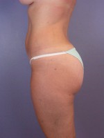 Liposuction Before and after photo