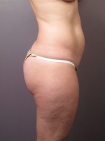 Liposuction Before and after photo