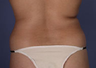 Liposuction before and after photo