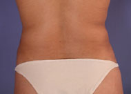 Liposuction before and after photo