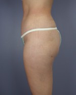 Liposuction Before and after photo