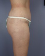 Liposuction Before and after photo