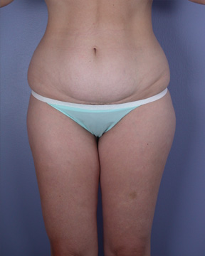 Liposuction before and after photo