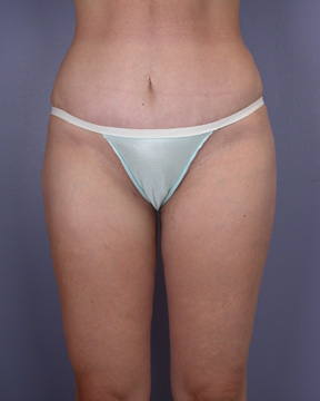 Liposuction before and after photo