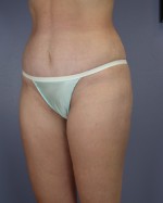 Liposuction Before and after photo