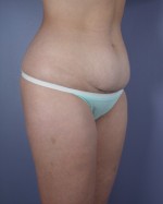 Liposuction Before and after photo