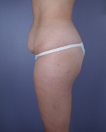 Liposuction Before and after photo