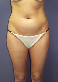 Liposuction before and after photo