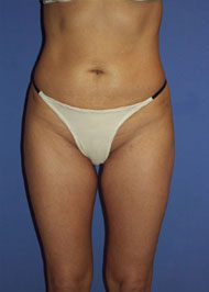 Liposuction before and after photo