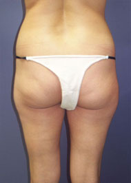 Liposuction before and after photo