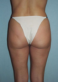 Liposuction before and after photo