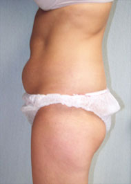 Liposuction before and after photo