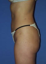 Liposuction Before and after photo