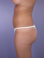 Liposuction Before and after photo