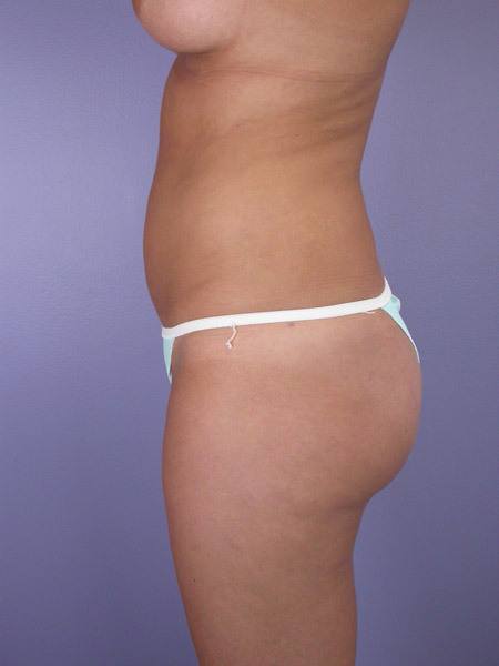 Liposuction before and after photo