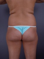 Liposuction Before and after photo