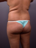 Liposuction Before and after photo