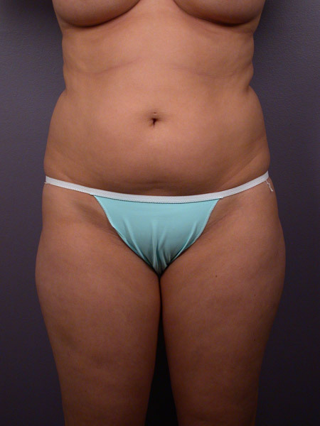 Liposuction before and after photo