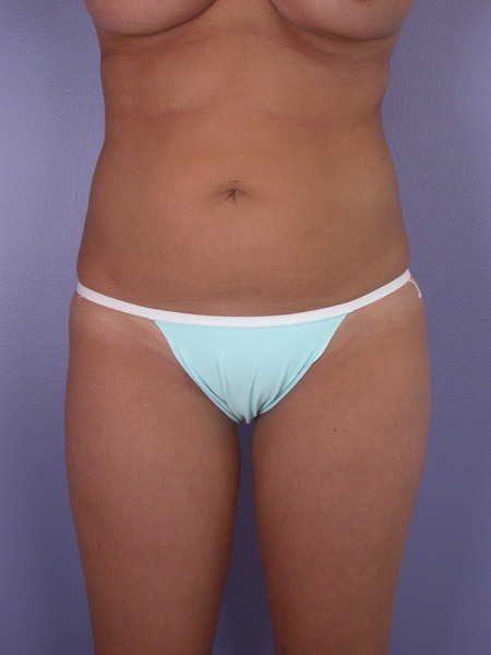 Liposuction before and after photo