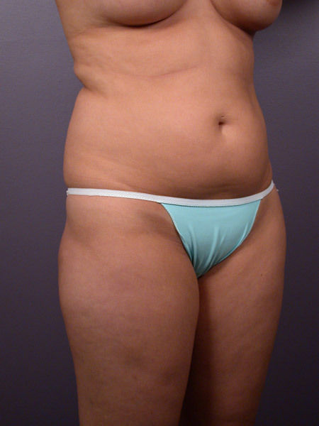 Liposuction before and after photo