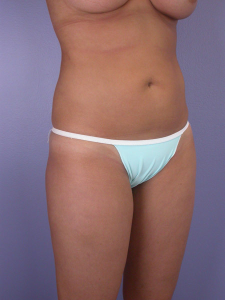 Liposuction before and after photo