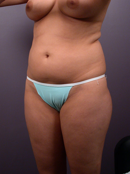 Liposuction before and after photo