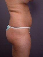 Liposuction Before and after photo