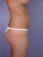 Liposuction Before and after photo