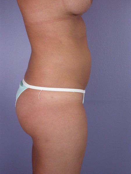 Liposuction before and after photo