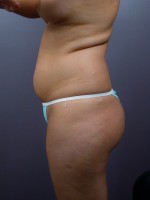 Liposuction Before and after photo