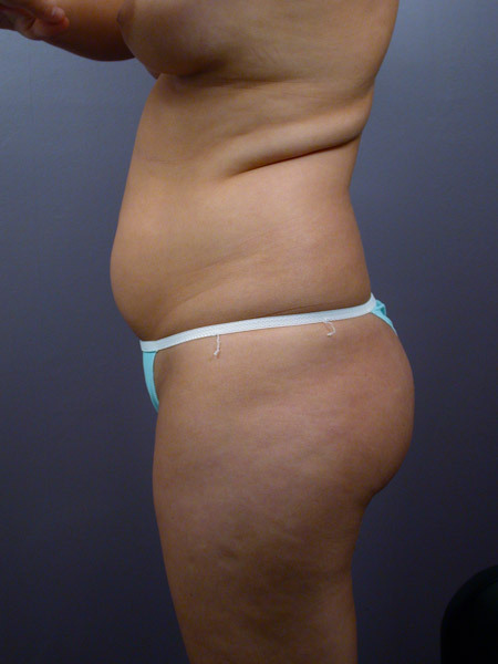 Liposuction before and after photo