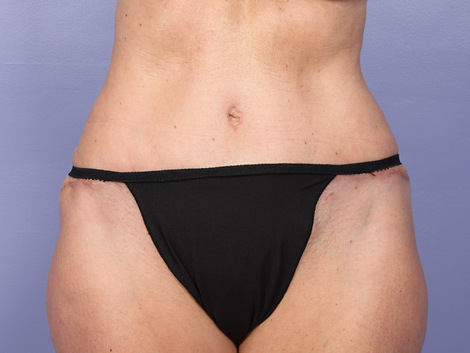 Liposuction before and after photo