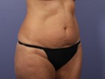 Liposuction