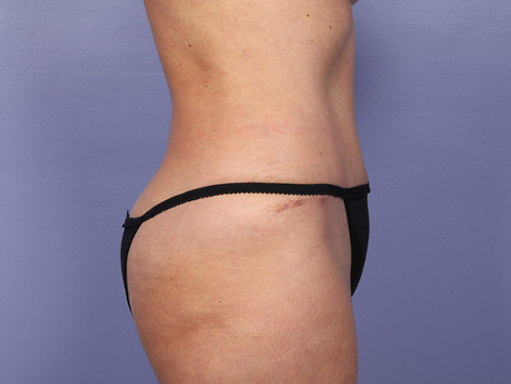 Liposuction before and after photo