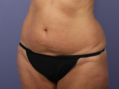 Liposuction before and after photo