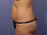 Liposuction Before and after photo