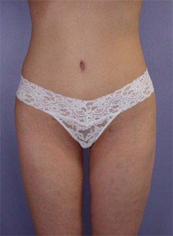 Liposuction before and after photo