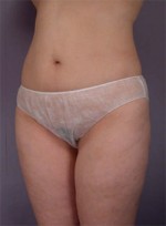 Liposuction