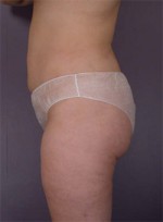 Liposuction Before and after photo