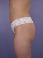 Liposuction Before and after photo