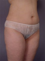 Liposuction Before and after photo