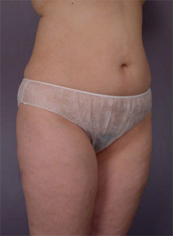 Liposuction before and after photo