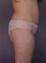 Liposuction Before and after photo