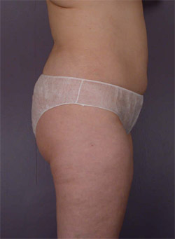 Liposuction before and after photo